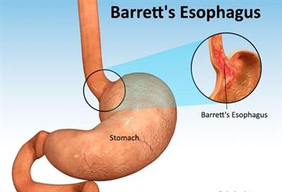 Barrett thực quản là gì? Cách nhận biết và điều trị