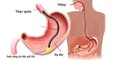 Viêm loét dạ dày: Nguyên nhân, triệu chứng và cách khắc phục